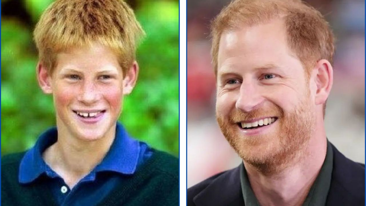 Príncipe Harry con ortodoncia antes y después