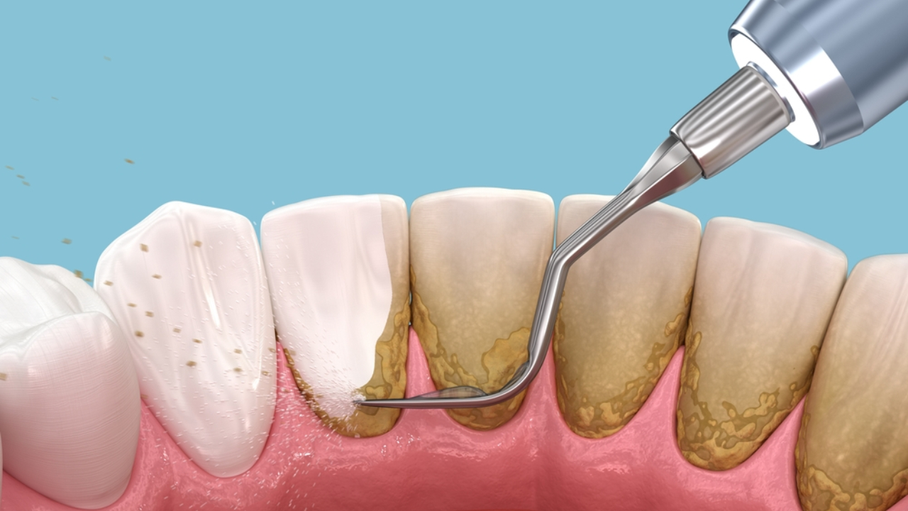 Raspado y alisado radicular para detener la periodontitis