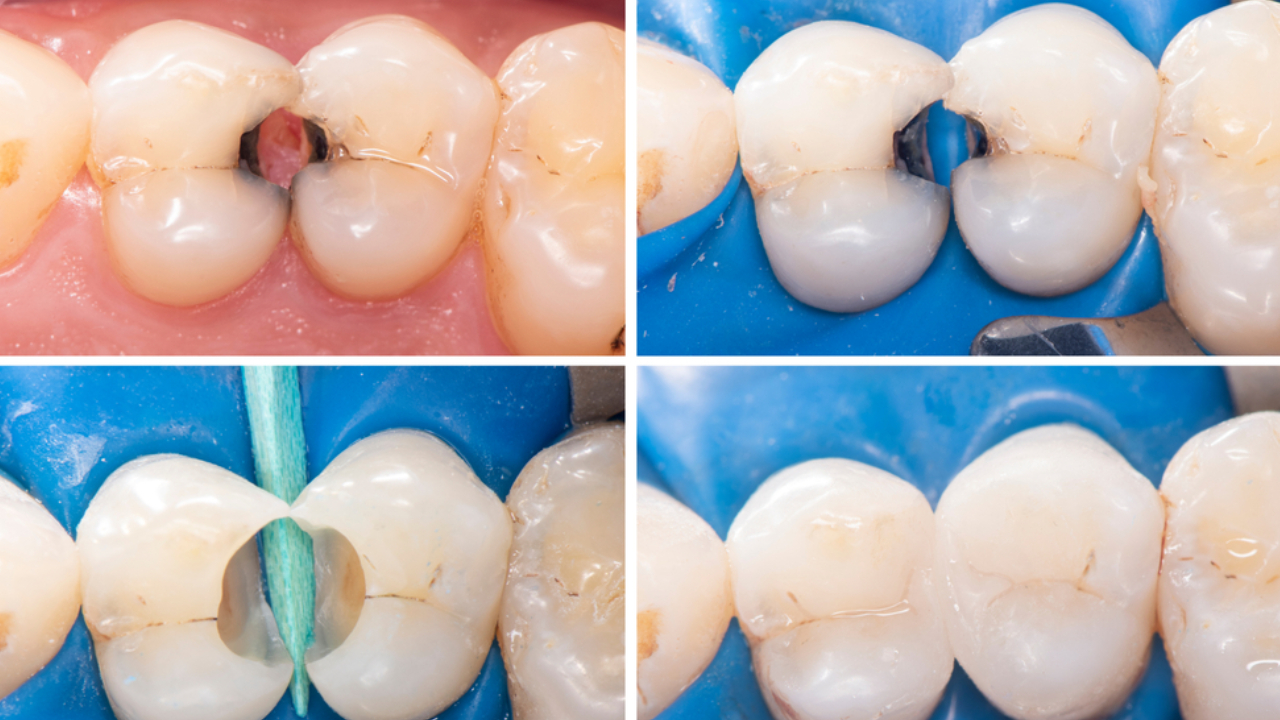 Sensibilidad dental tras empaste