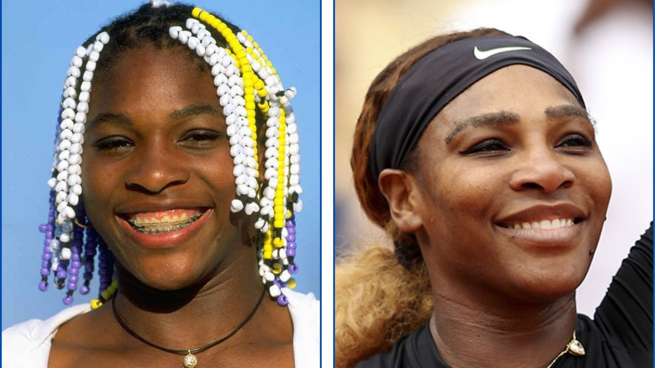 Serena Williams con ortodoncia antes y después