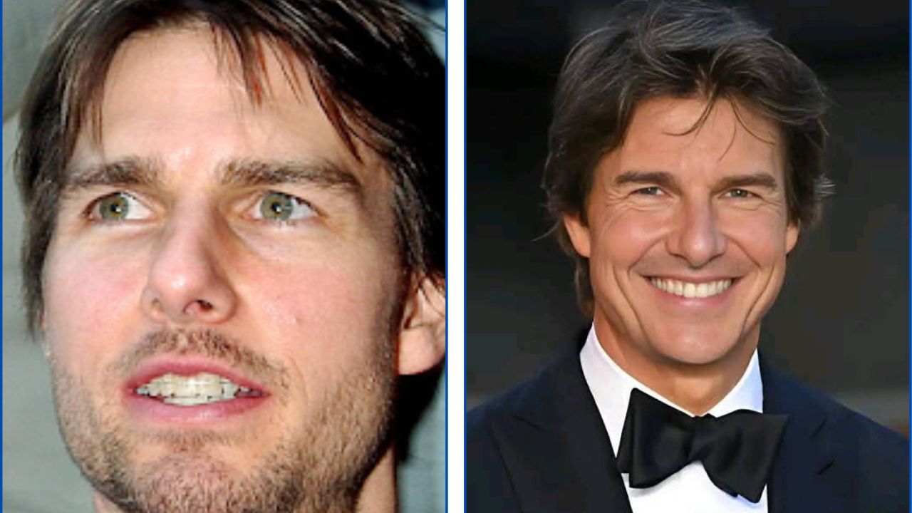 Tom Cruise con ortodoncia antes y después