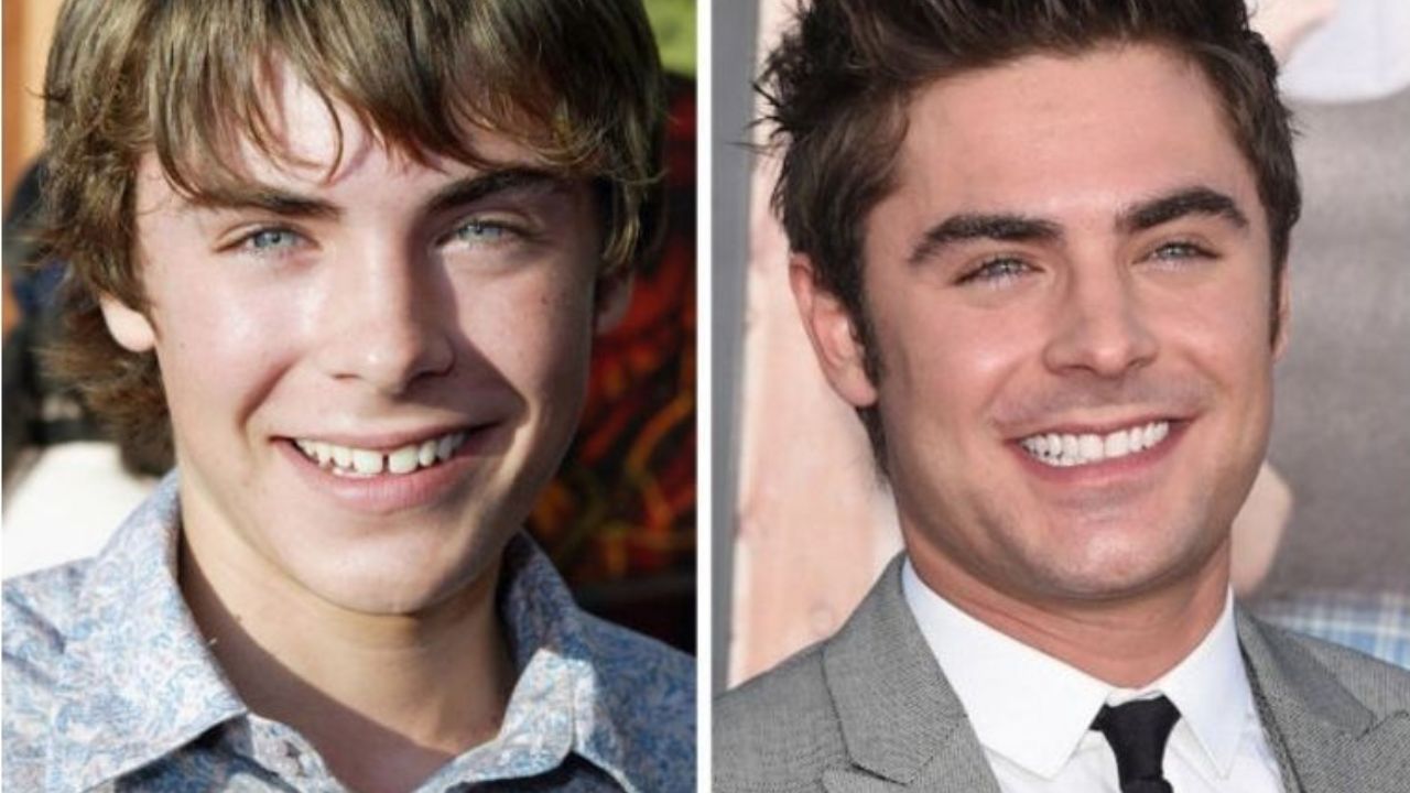 Zac Efron con ortodoncia antes y después