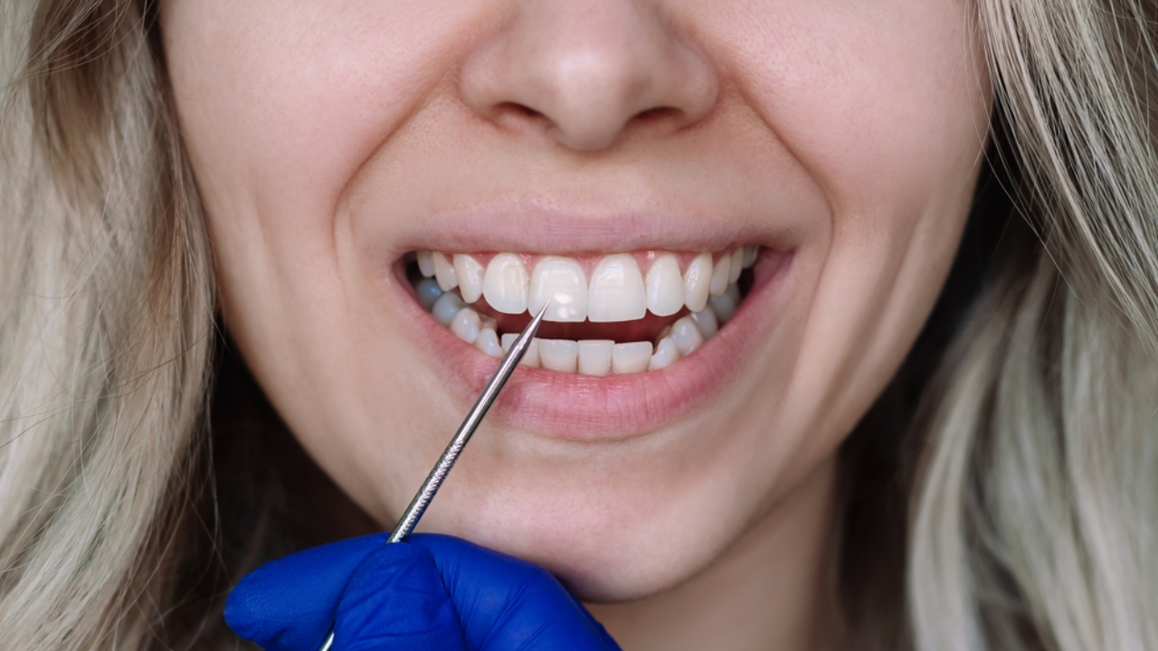 Caries interproximal incipiente