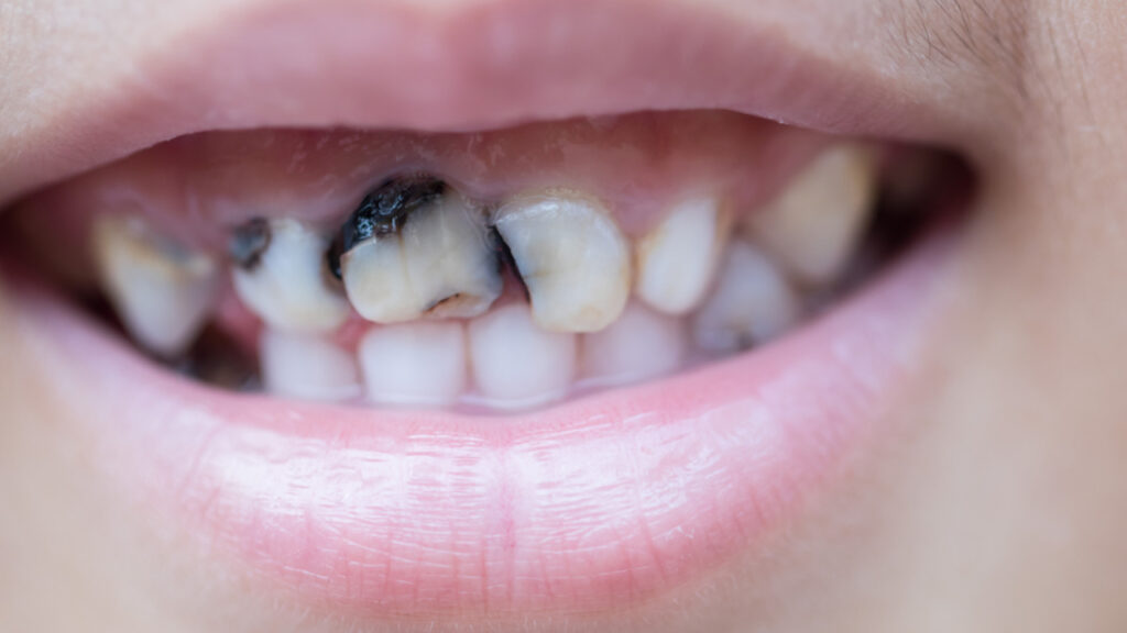 Dientes negros: Causas comunes y soluciones para recuperar tu sonrisa