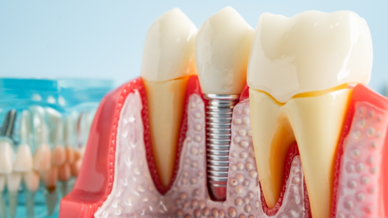 Extracción y colocación de implante dental