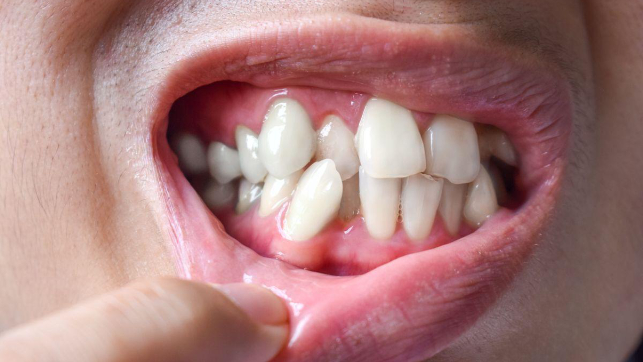 Hiperdoncia: ¿Qué son los dientes supernumerarios y cómo afecta la salud bucal?