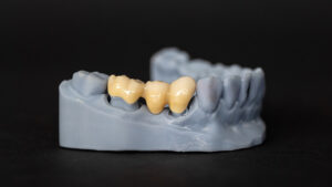 Puente dental fijo: qué es, tipos, pros, contras y cuidados