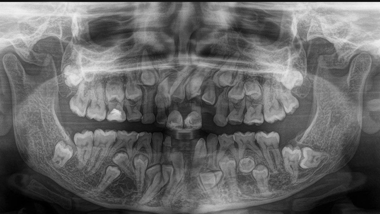 Síndrome cleidocraneal