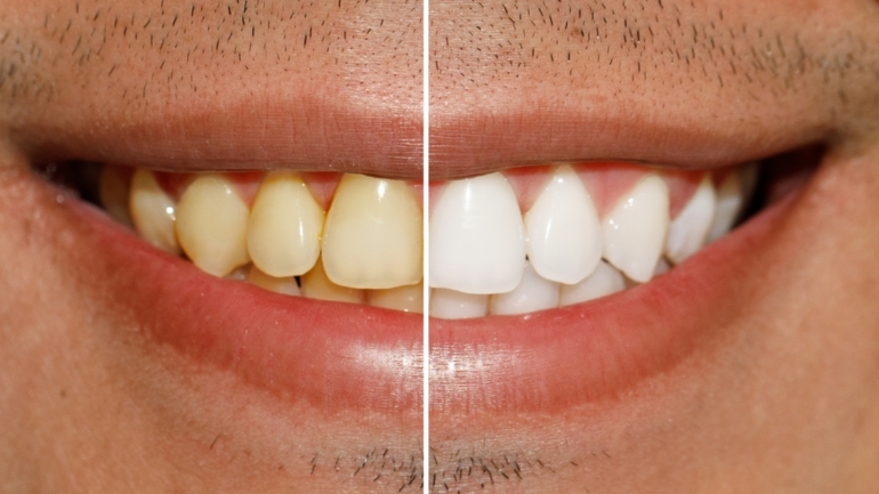 Antes y después de blanqueamiento dental para corregir la hipoplasia dental