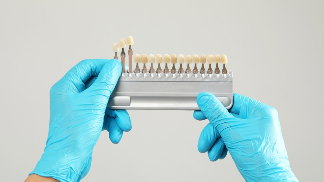 Carillas dentales para hipoplasia dental