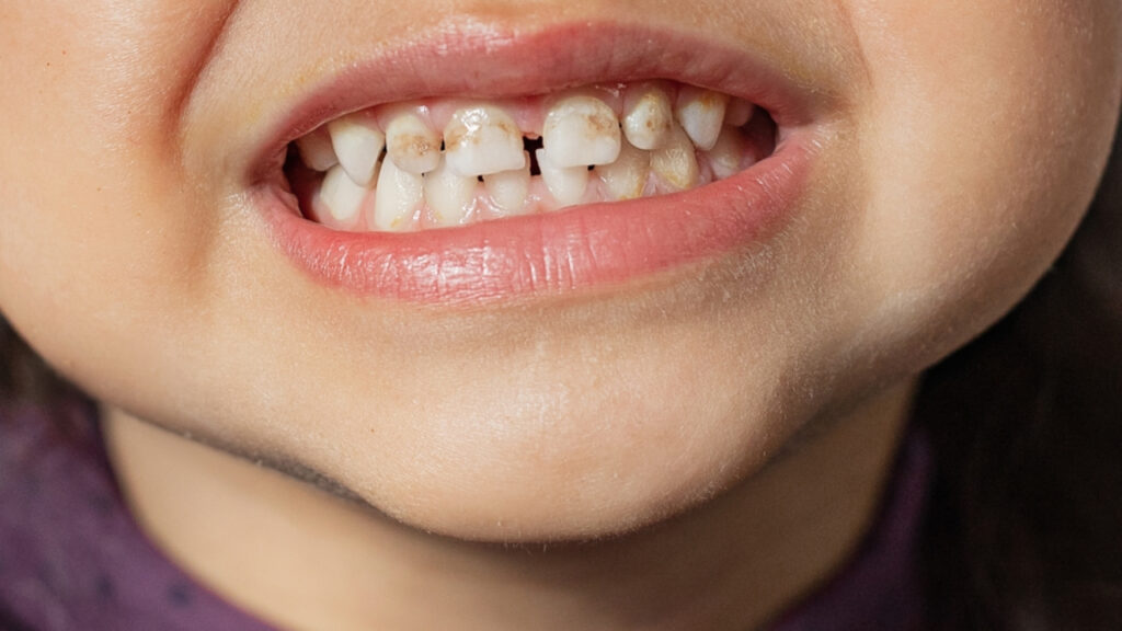 Hipoplasia dental: causas, síntomas y 6 opciones de tratamiento