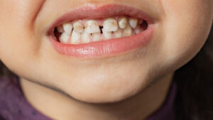 Hipoplasia dental: causas, síntomas y 6 opciones de tratamiento