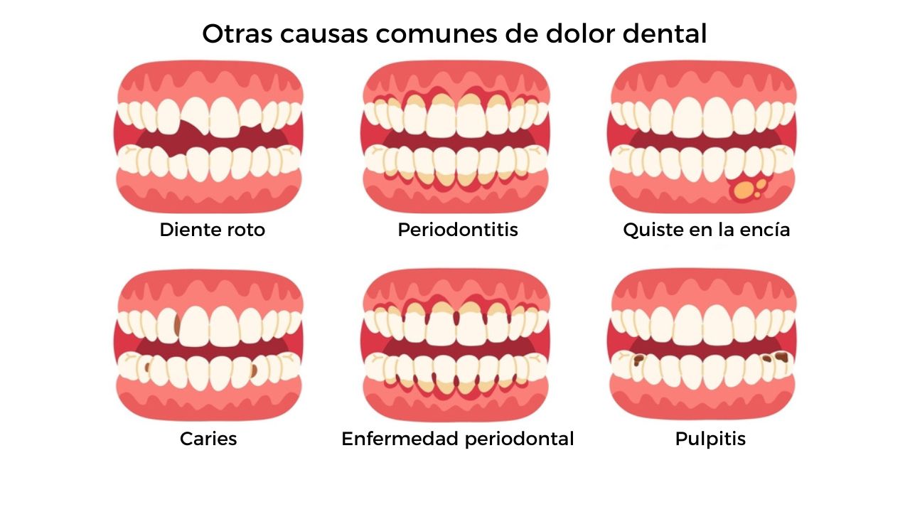 Otras causas comunes de dolor dental