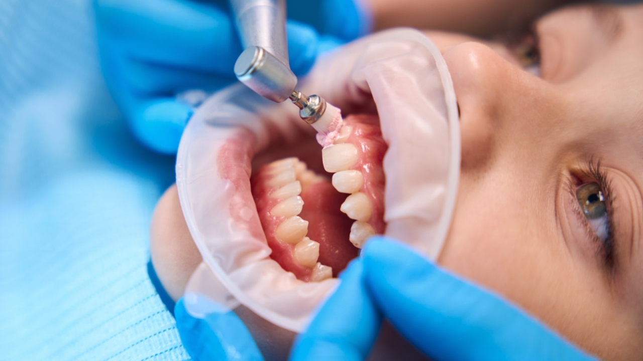 Pulido dental para tratar hipoplasia