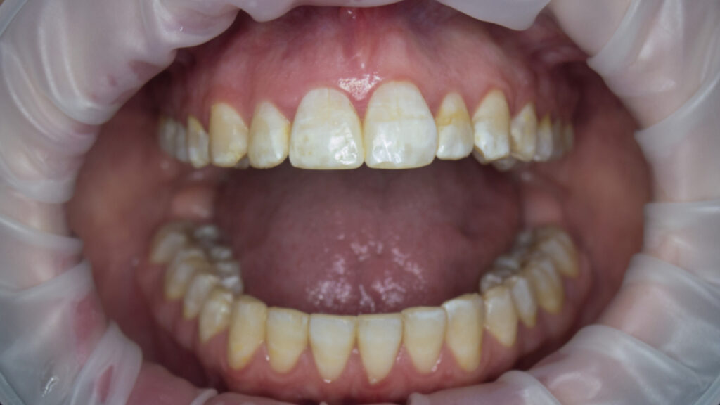 Qué es la fluorosis dental, causas y cómo tratar esta afección en los dientes