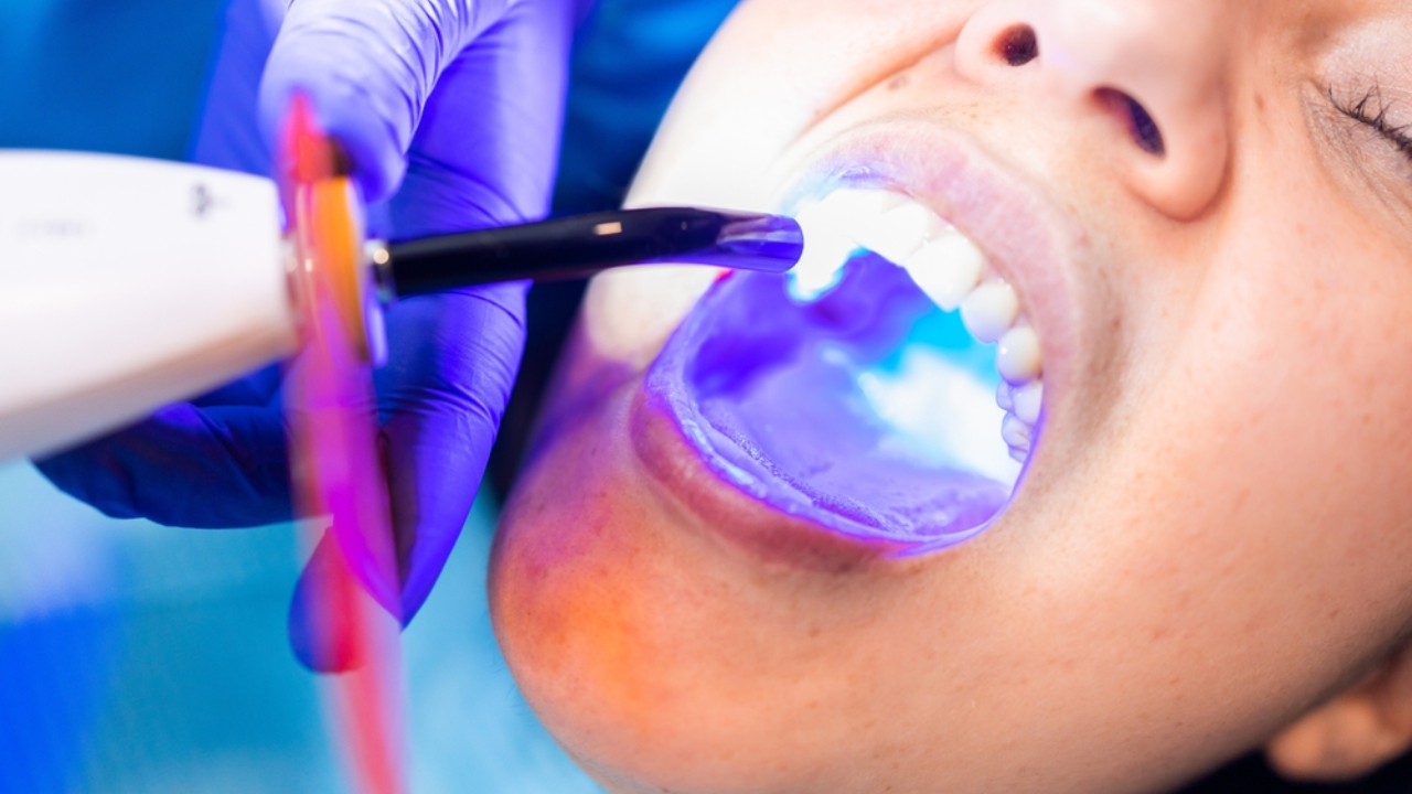 Reconstrucción dental con composite para tratar hipoplasia