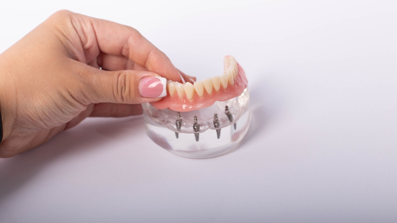 Tipos de prótesis dentales fijas  