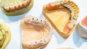 Tipos de prótesis dentales: ¿Cuál es la mejor opción para ti?