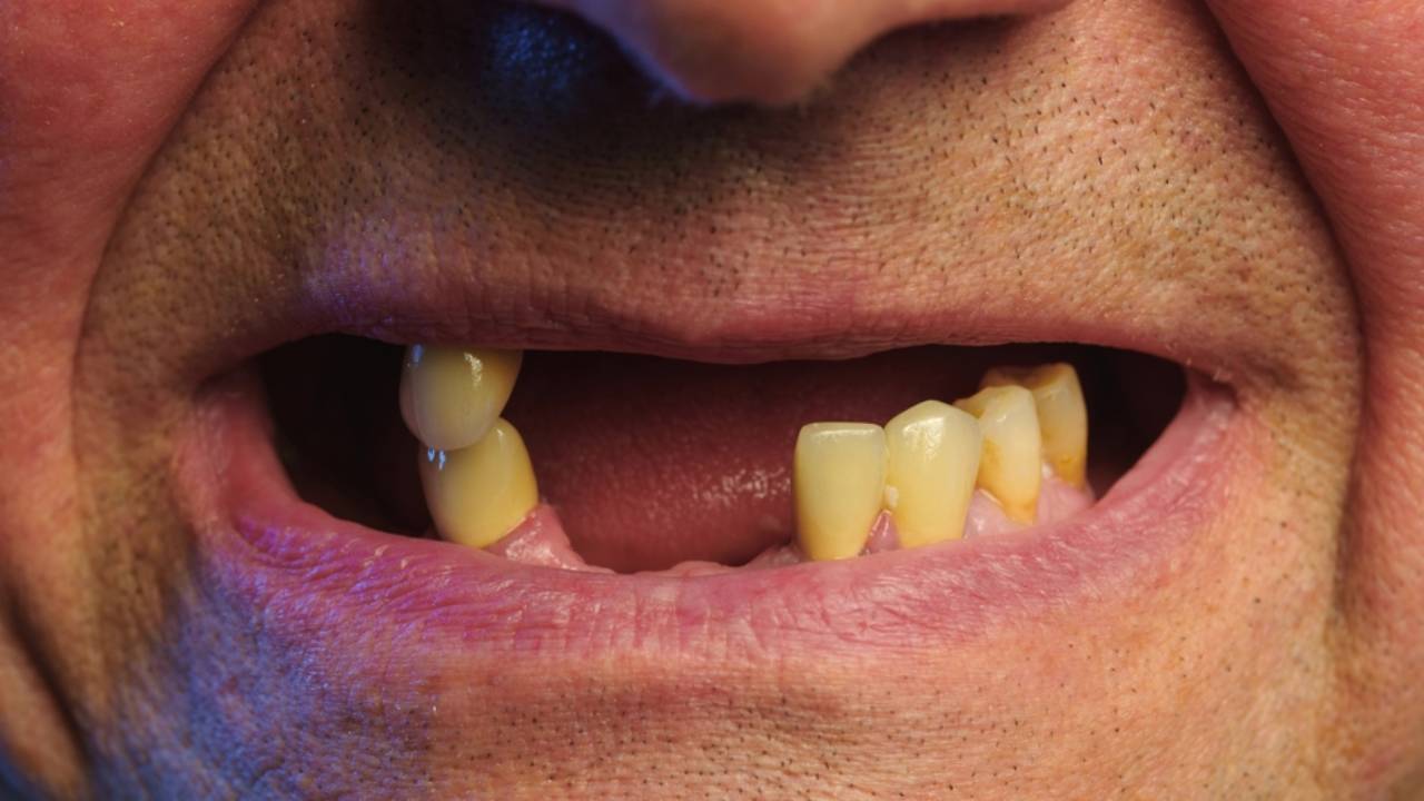 Cómo prevenir y tratar la pérdida dental para recuperar tu sonrisa