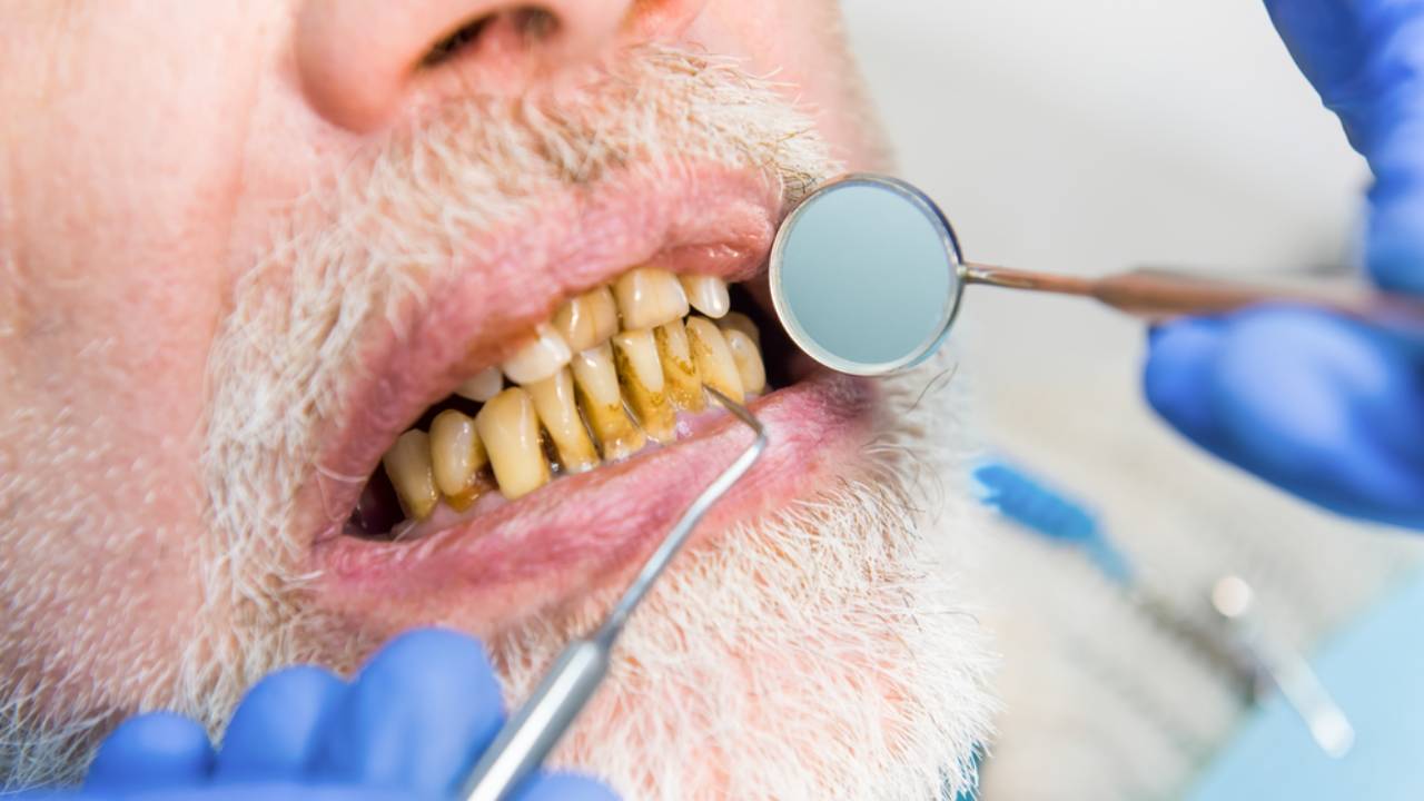 Dientes amarillos de un fumador