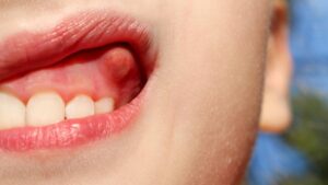 Fístula dental: cómo detectarla, tratamientos y consejos para prevenirla