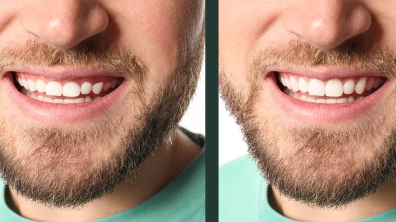 Gingivectomía antes y después