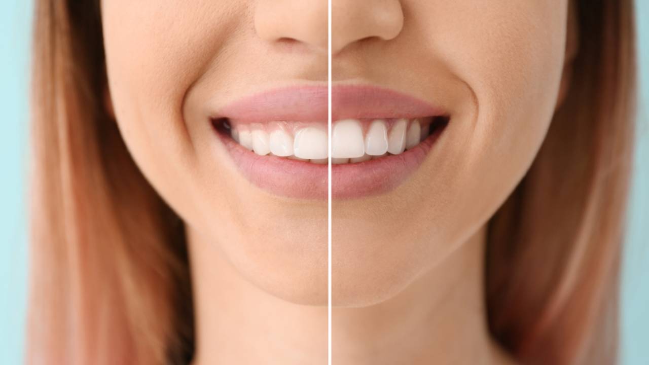Gingivectomía: en qué consiste, ventajas y cuándo es necesaria