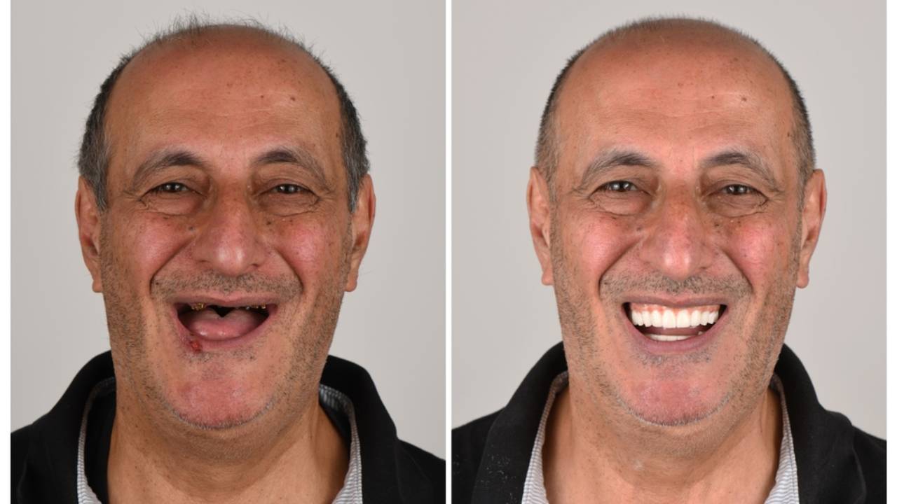 Paciente con implantes dentales