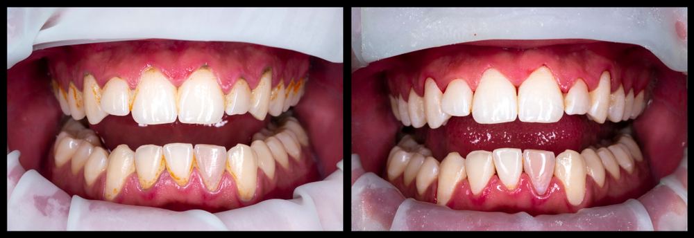 Limpieza dental antes y después