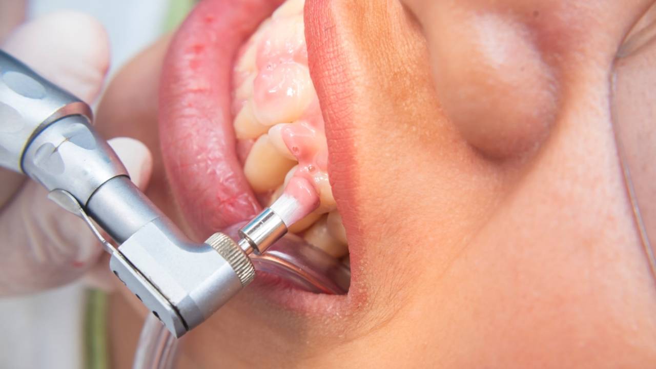 Microabrasión dental para dientes amarillos