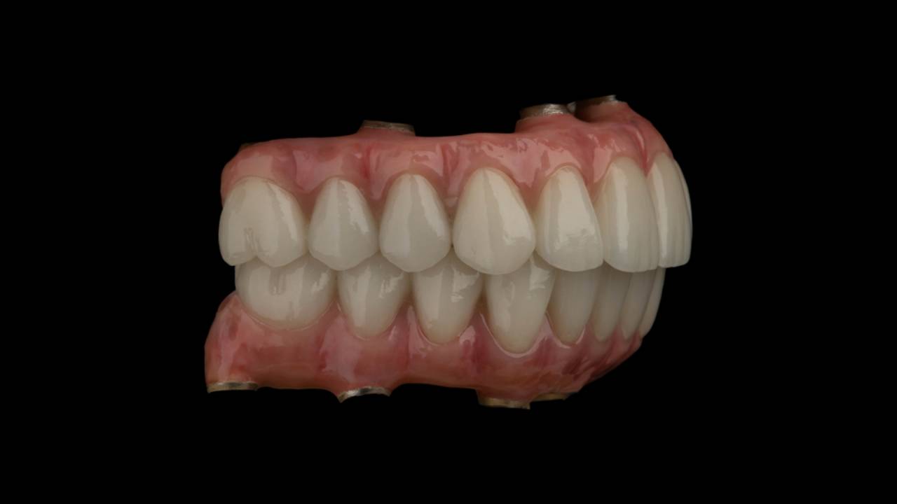 Puentes dentales fijos